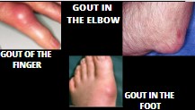 PHOTO SHOWING EVIDENCE OF GOUT IN FINGER,ELBOW AND TOE. AS PART OF GOUT THE DISEASE OF KINGS.