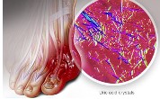 GOUT DISEASE OF THE KINGS, PHOTO SHOWING URIC ACID CRYSTALS FORMING IN THE JOINT CAUSING GOUT