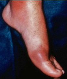 A PHOTO SHOWING GOUT OF THE FOOT IN ALL THING HEALTH AND FITNESS