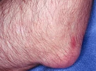 ALL THINGS HEALTH & YOUR FITNESS  AN Elbow affected by Gout Red and swollen